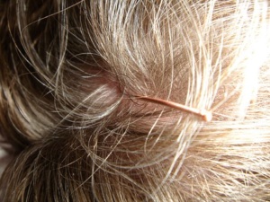 hair transplant