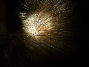 hair transplant 